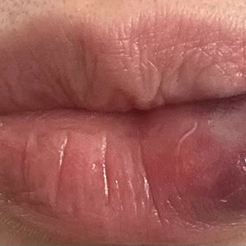 Didem Toktaş Beauty Güzellik Merkezinde Yaşanan Dudak Dolgusu Problemleri