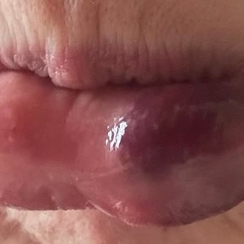 Didem Toktaş Beauty Güzellik Merkezinde Yaşanan Dudak Dolgusu Problemleri