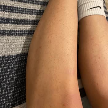 Veet Marka Tüy Dökücü Bacağıma Zarar Verdi