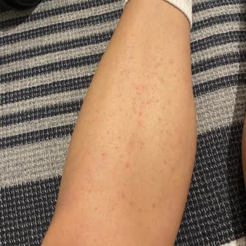 Veet Marka Tüy Dökücü Bacağıma Zarar Verdi