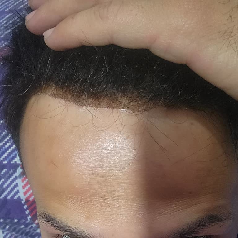 Woynn Hair Protez Saç Kalitesi Sıfır