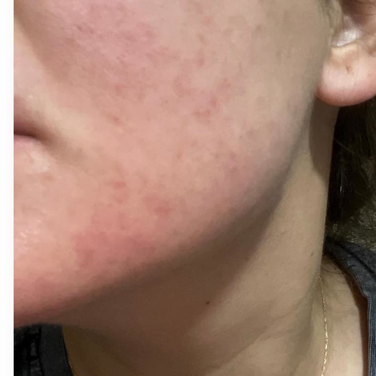 L'Oreal Revitalift Caused Skin Discomfort