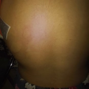 Torku Çocuğumda Alerjiye Neden Olan Kakaolu Fındık Kreması