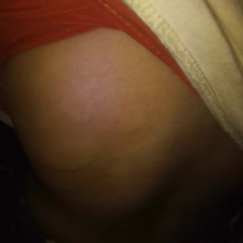 Torku Çocuğumda Alerjiye Neden Olan Kakaolu Fındık Kreması