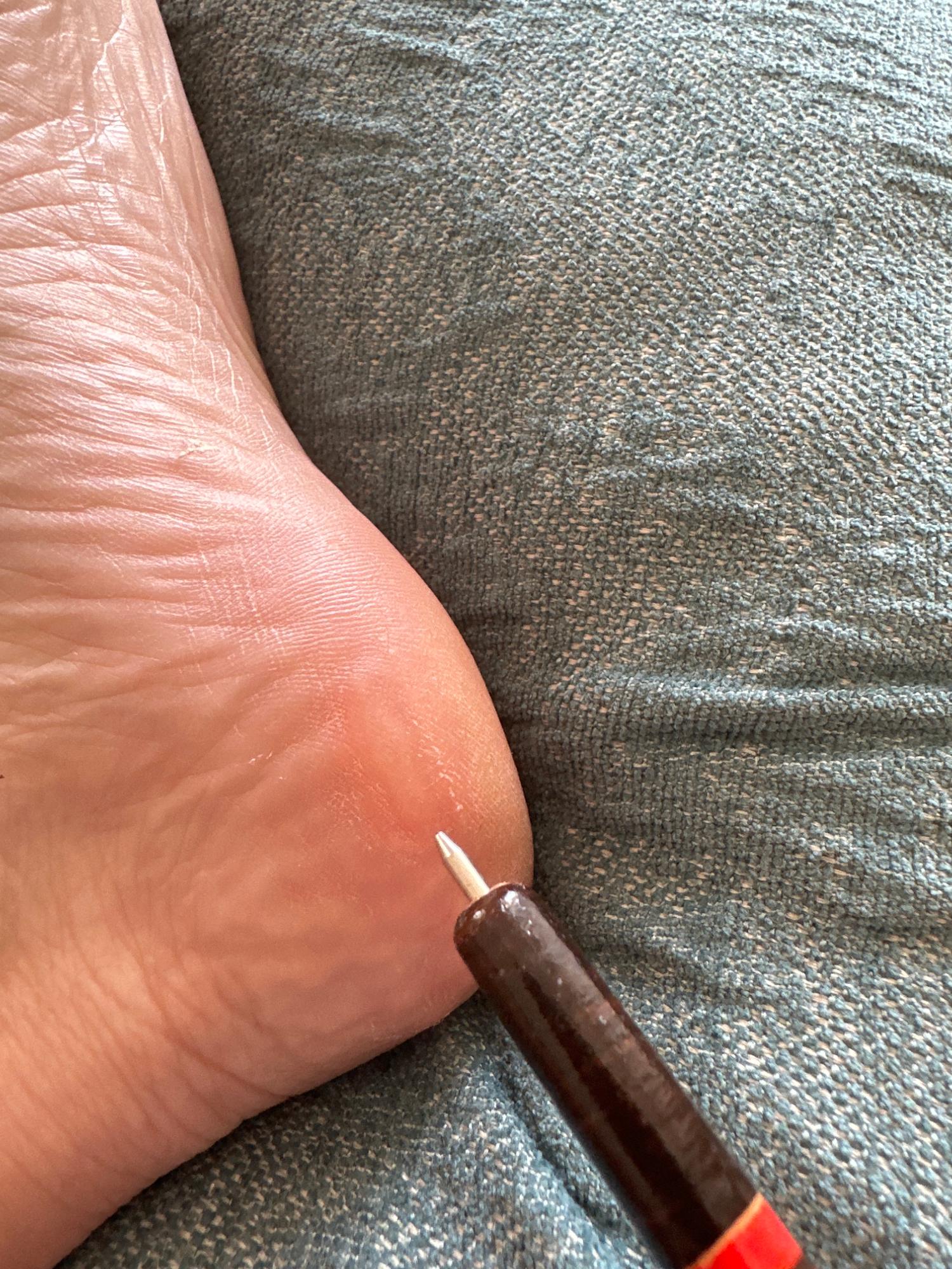 Asics Gel Nimbus 26 Shoes Caused Blisters & Toe Injury Xolvie