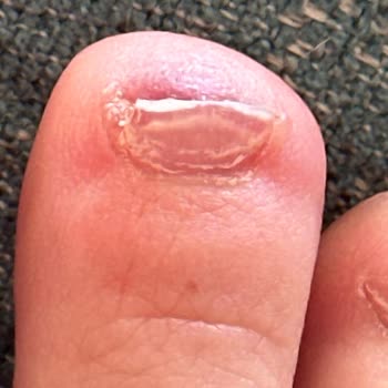 Asics Gel Nimbus 26 Shoes Caused Blisters & Toe Injury