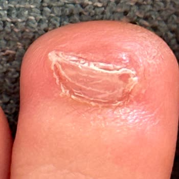 Asics Gel Nimbus 26 Shoes Caused Blisters & Toe Injury