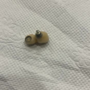 Cerrahi Grup Ağız ve Diş Sağlığı Polikliniği Yapılan İmplantların Ve Diğer İşlemlerin Kırılması Ve Çıkması,