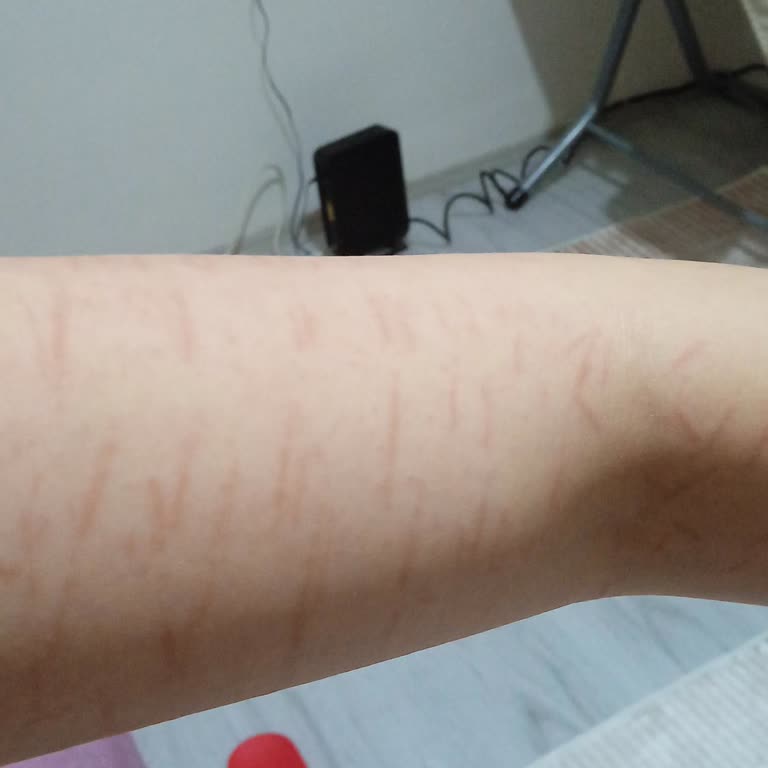 Derya Demir Güzellik Merkezi Cildimi Yaktılar Kolum Acıyor Yanık Yanık