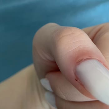 Berna Nail Halkalı Parmağım İltihap Kaptı Hijyen 0