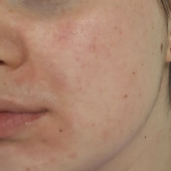 Yves Rocher Yüzüm Tahriş Ve Alerji Oldu