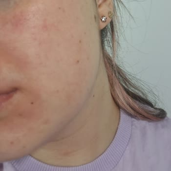 Yves Rocher Yüzüm Tahriş Ve Alerji Oldu