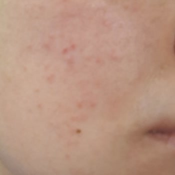 Yves Rocher Yüzüm Tahriş Ve Alerji Oldu