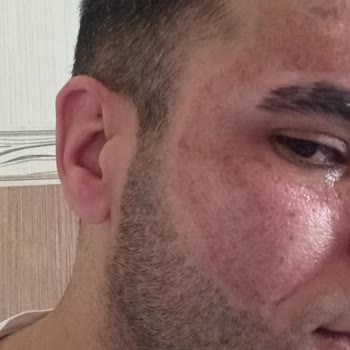 Dilan Cömertler Plazma Pen Pişmanlığı