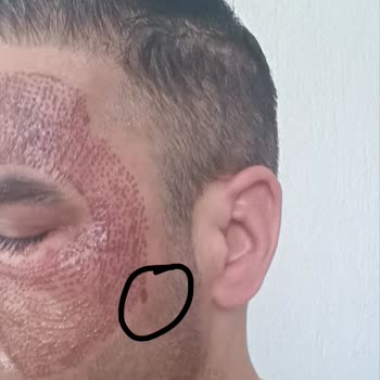 Dilan Cömertler Plazma Pen Pişmanlığı