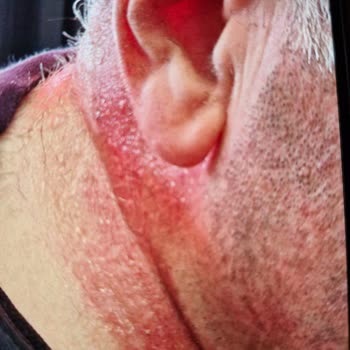 Dilek Pastanesi Başımızdan Aşağı Cay Döküp Yaktılar