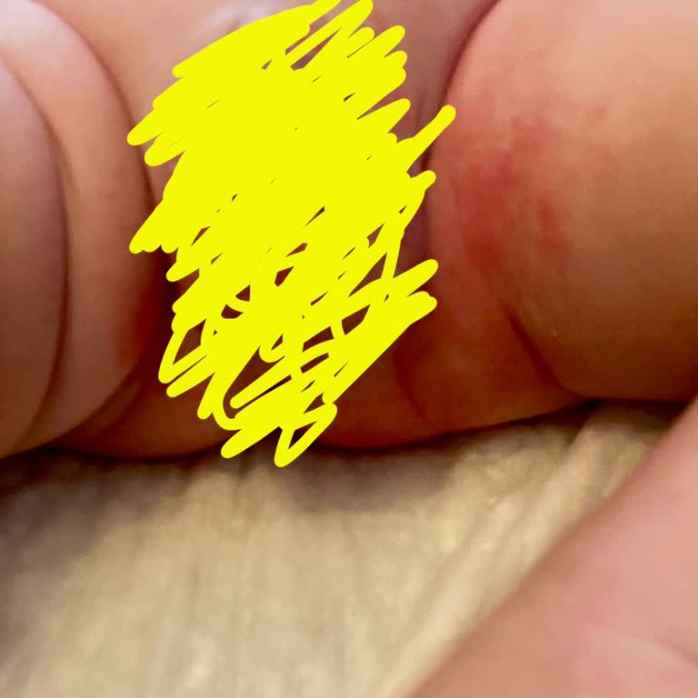 Sleepy Natural Pişik Döküntü Kızarıklık Yaptı