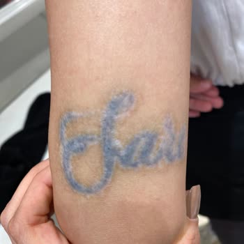 Medica Derma Dövme Silme