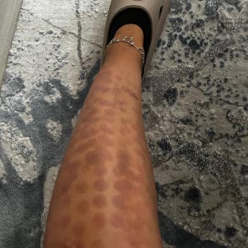 Lazer Epilasyon Yanığı - Eryaman Ortadoğu Asg Tıp Merkezi