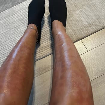 Lazer Epilasyon Yanığı - Eryaman Ortadoğu Asg Tıp Merkezi