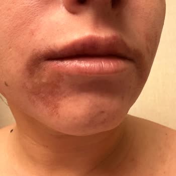 Aris Ezgi Doğan Polikliniği Estetik Uygulamalarında Yaşanan Hayal Kırıklığı