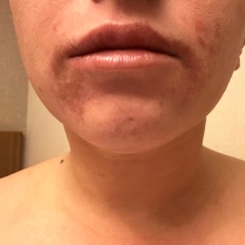 Aris Ezgi Doğan Polikliniği Estetik Uygulamalarında Yaşanan Hayal Kırıklığı