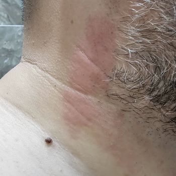 Yunus Market Yüzümde Tahrişe Neden Olan Tıraş Bıçağı