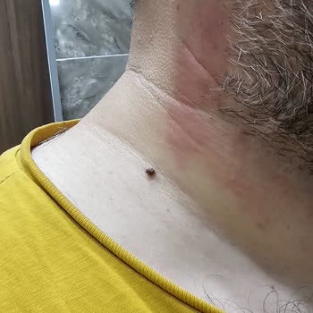 Yunus Market Yüzümde Tahrişe Neden Olan Tıraş Bıçağı