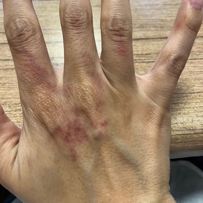 Emsan Kusurlu Çaydanlık Elimin Yanmasına Sebep Oldu