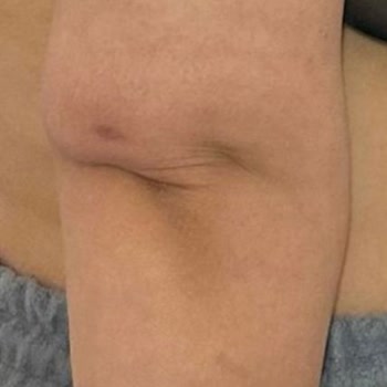 Estecenter Kol Germe Ameliyatı