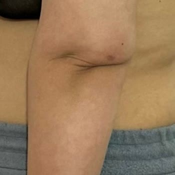 Estecenter Kol Germe Ameliyatı