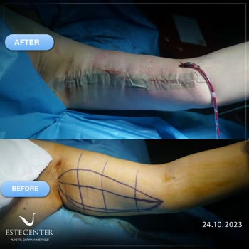 Estecenter Kol Germe Ameliyatı