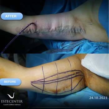 Estecenter Kol Germe Ameliyatı