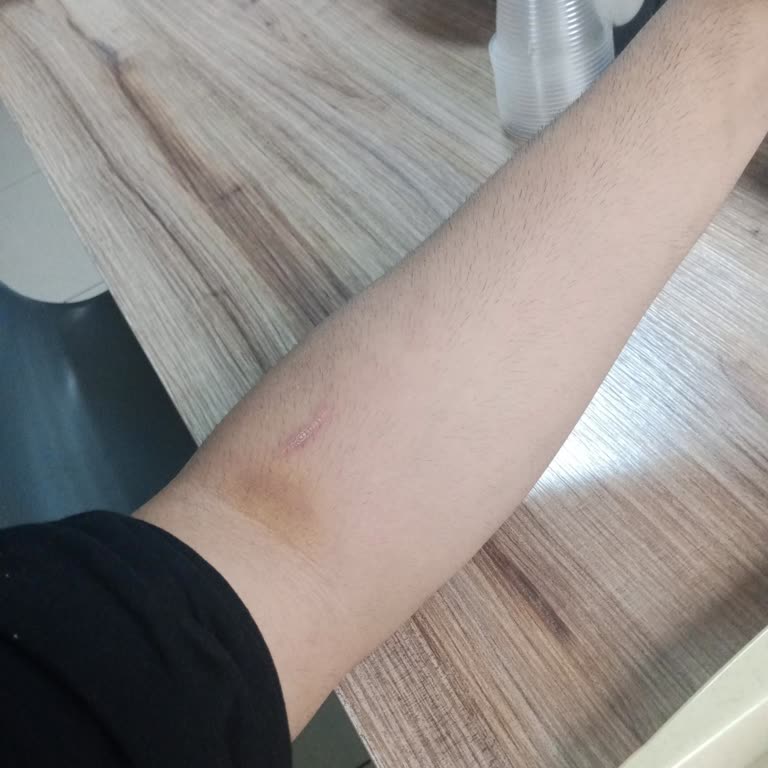 Doruk Yıldırım Hastanesi Kan Alma Serum Takma Acemiliği