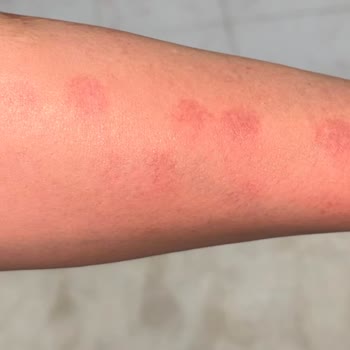 Gh Estetik Op. Dr. İlhan Pekdemir Kliniği Lazer Epilasyon Yanığı