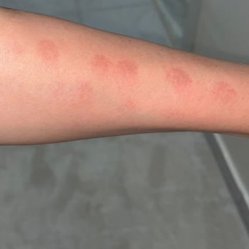 Gh Estetik Op. Dr. İlhan Pekdemir Kliniği Lazer Epilasyon Yanığı