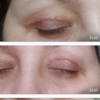 Op. Dr. Ali Cemal Yılmaz  Göz Kapağı Estetiği Mağduru!