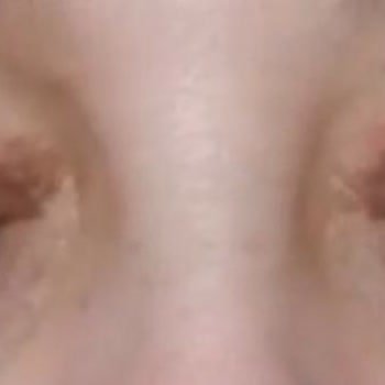 Op. Dr. Ali Cemal Yılmaz  Göz Kapağı Estetiği Mağduru!