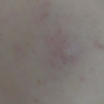 Gratis Beaulis Tarihi Geçmiş Ürün Cildime Verdiği Zarar Şikayet