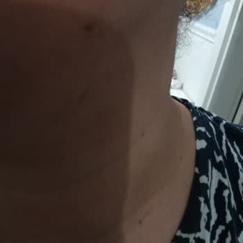 Solante Acnes Cildime Hiç İyi Gelmedi