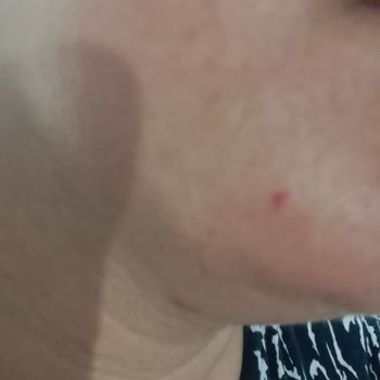 Solante Acnes Cildime Hiç İyi Gelmedi