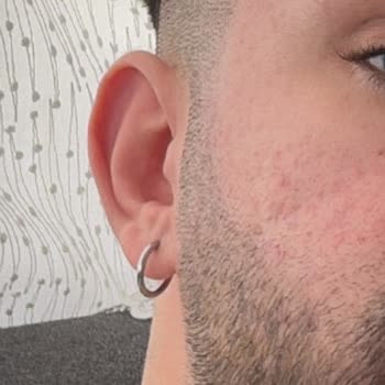 La Roche - Posay Effaclar Serum Kullanımı Sonrası Ciltte Yanma Şikayeti