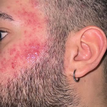 La Roche - Posay Effaclar Serum Kullanımı Sonrası Ciltte Yanma Şikayeti