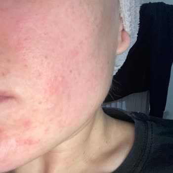 Cream Co. Pembe Yüz Kremi Alerji Yaptı!