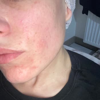 Cream Co. Pembe Yüz Kremi Alerji Yaptı!