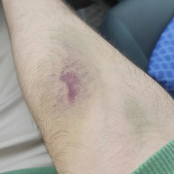 Özel Büyükşehir Hastanesinde Damarımı Patlattı