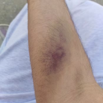 Özel Büyükşehir Hastanesinde Damarımı Patlattı