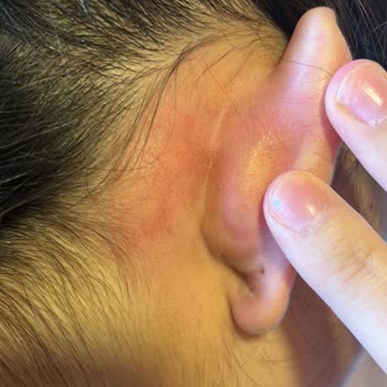 Dove Şampuanı Alerji Yaptı