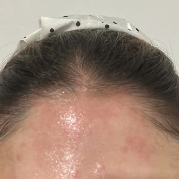 Dove Şampuanı Alerji Yaptı