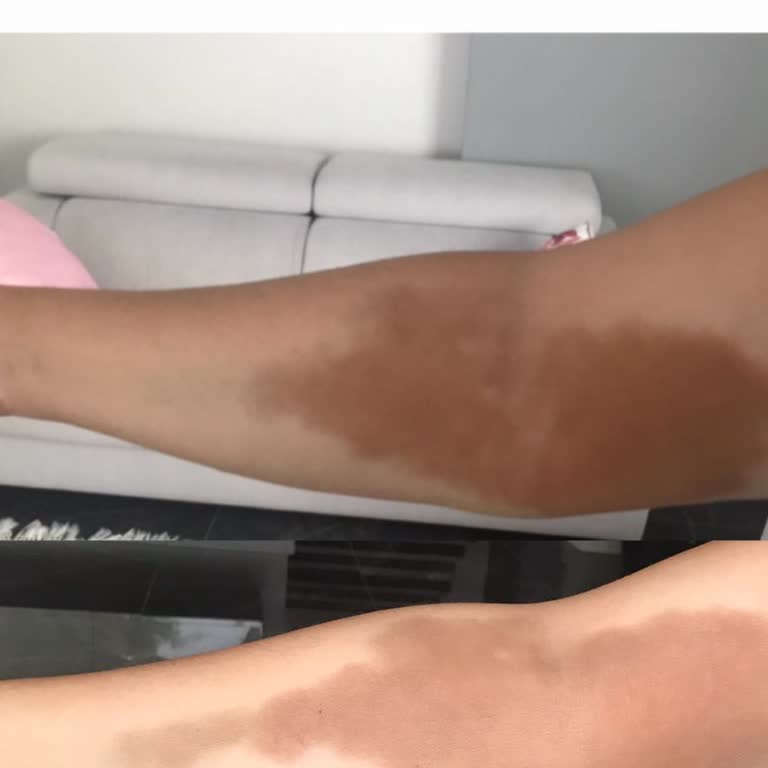 Yücelen Hastaneleri 9 Aydır Geçmeyen Serum İzleri: Deneyimlerinizi Paylaşın